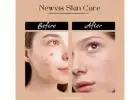 Newvis acne solution