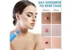 Full Body Skin Tag Remover Straight Sale - [US] For Smooth & Tag-Free Skin!
