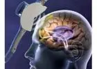 Cutting-Edge Solution for Depression: Trans Cranial Magnetic Stimulation Therapy